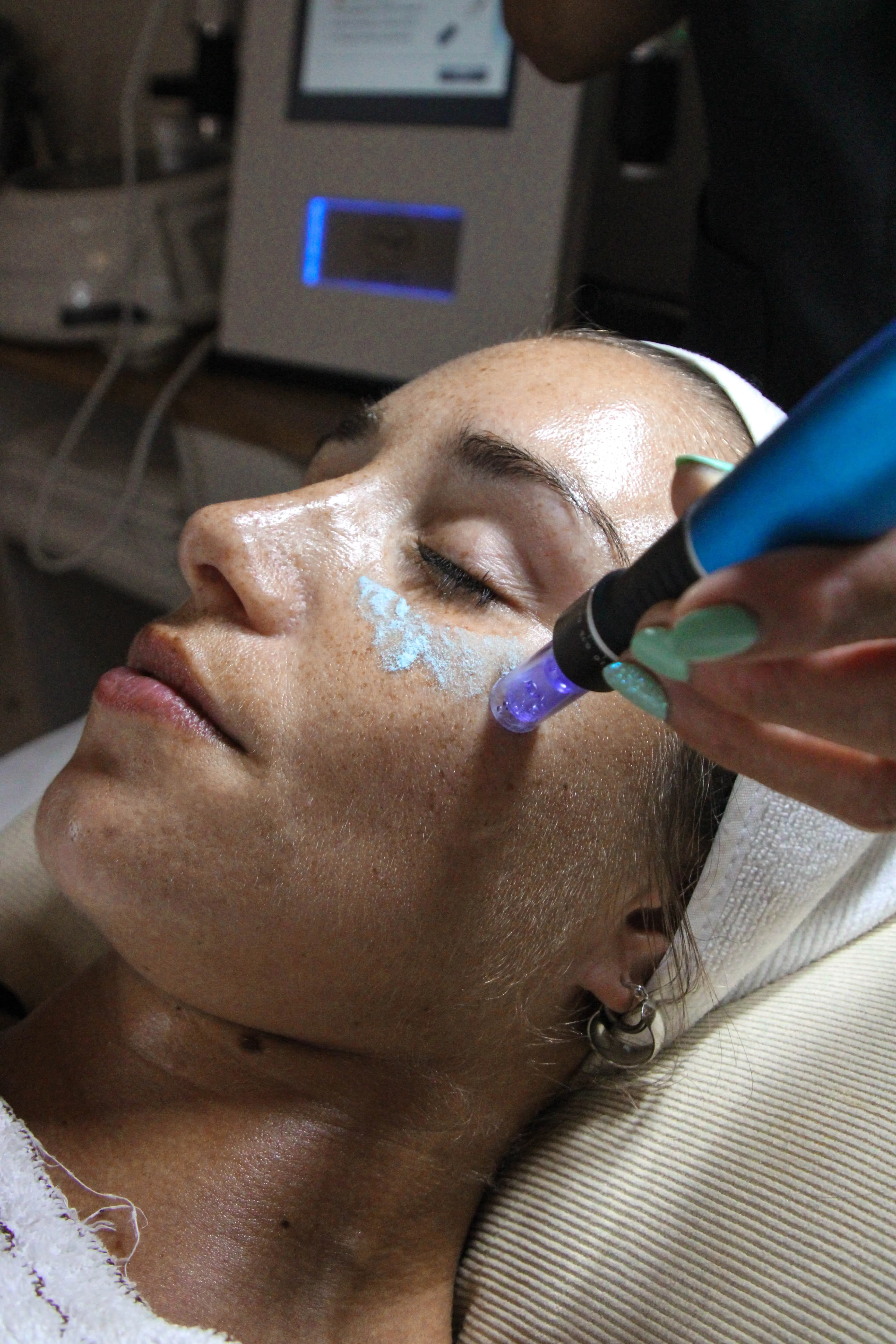 Tratamiento con dermapen